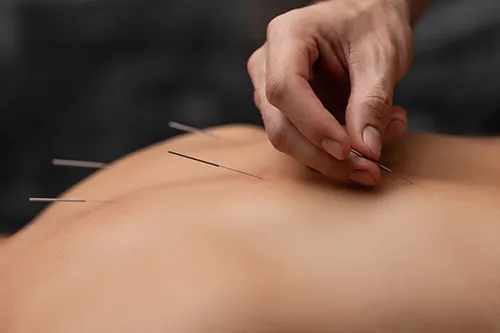 Acupuncture